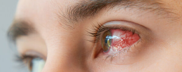 maladies des yeux